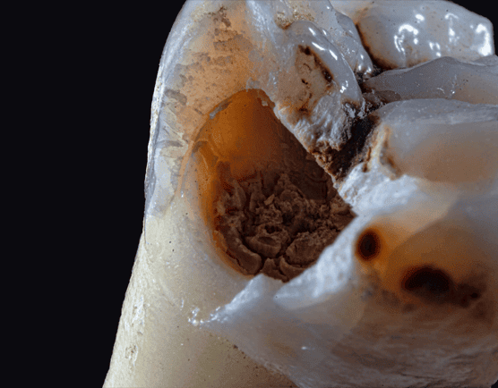 Цены удаление зубов